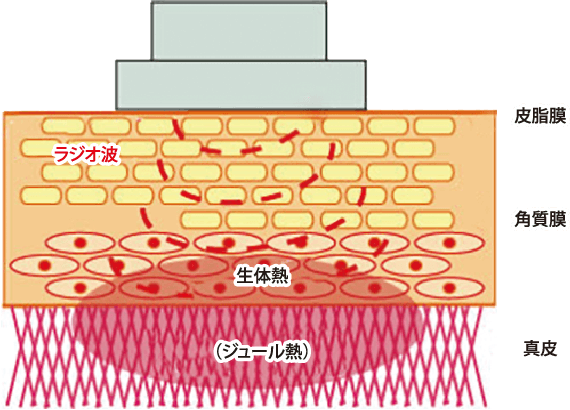 RF(ラジオ波)マッサージ